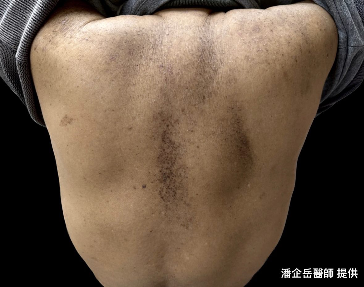 皮膚搔抓別過度，蟾蜍樣皮難去除