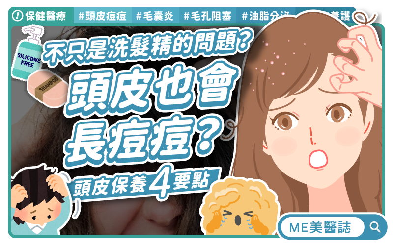 臉部痘痘OUT 頭皮痘痘才是夏季隱形殺手